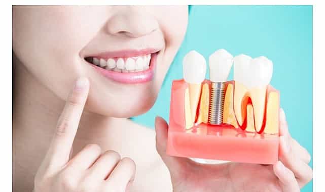 Diş İmplantları Hakkında Bilmeniz Gereken 9 Bilgi! görseli
