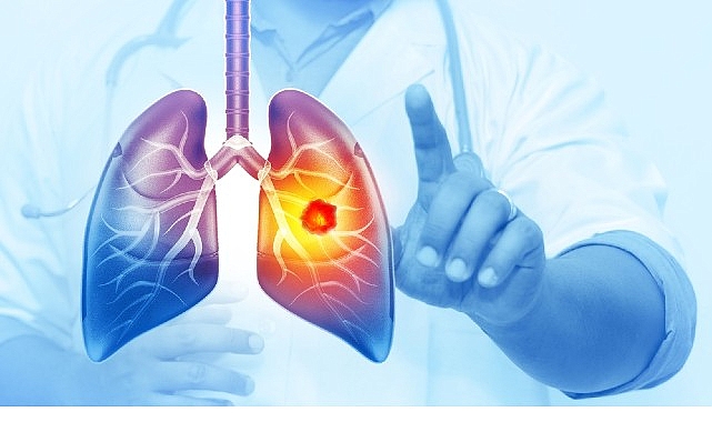 Her Yıl 25 Bin Akciğer Kanseri Vakası Önlenebilir görseli