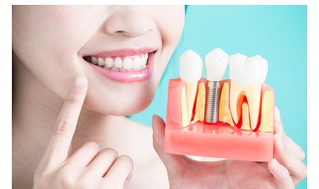 Diş İmplantları Hakkında Bilmeniz Gereken 9 Bilgi! görseli